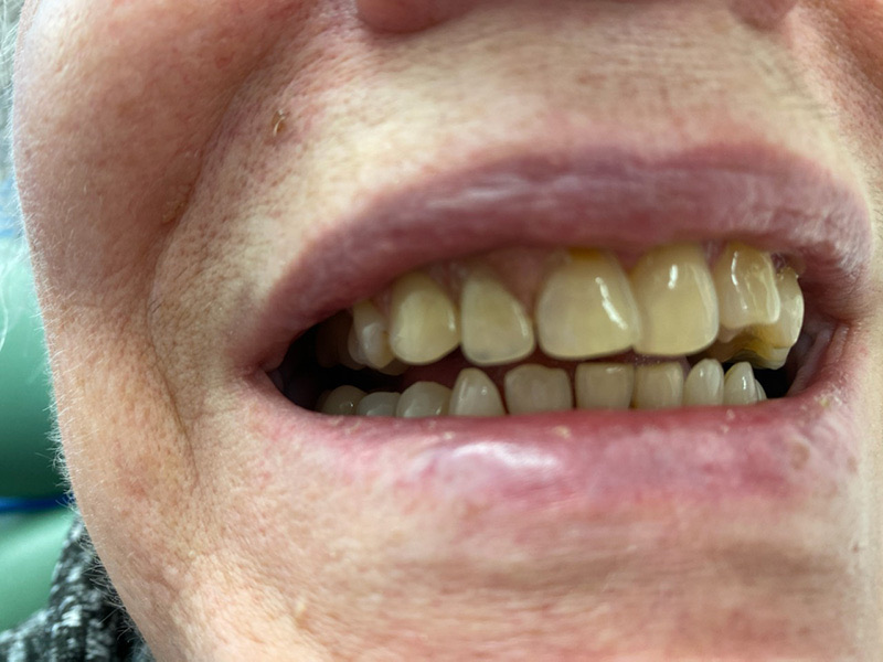 Patient smile after treatment at Montclair South Dental