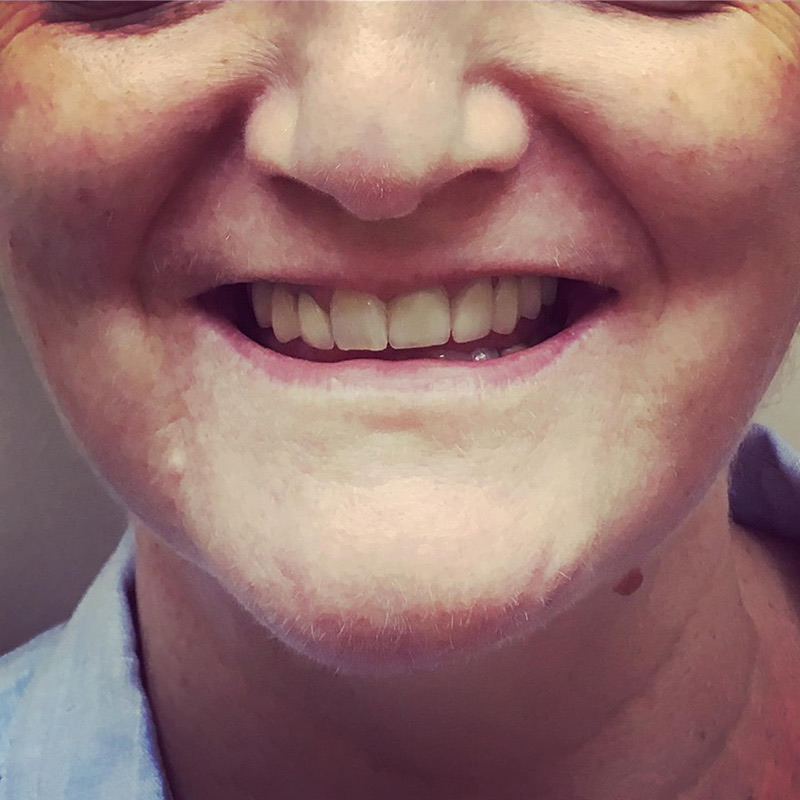 Patient smile after treatment at Montclair South Dental