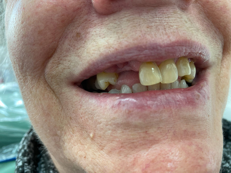 Patient smile before treatment at Montclair South Dental