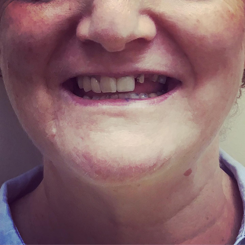 Patient smile before treatment at Montclair South Dental